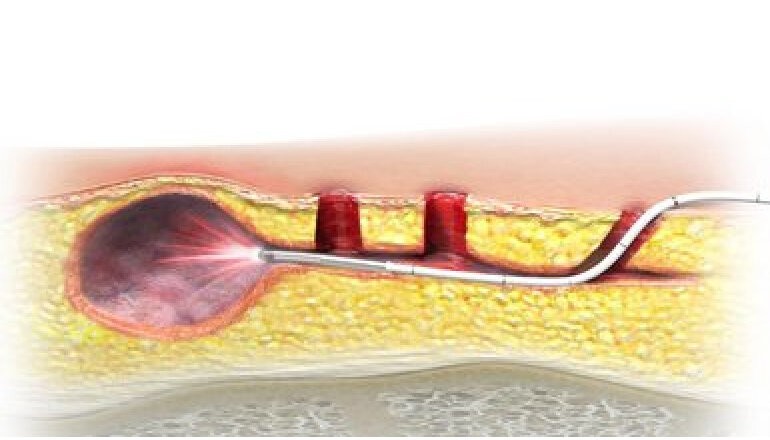 Sinus Laser Ablation Of Pilonidal Cyst Silac®