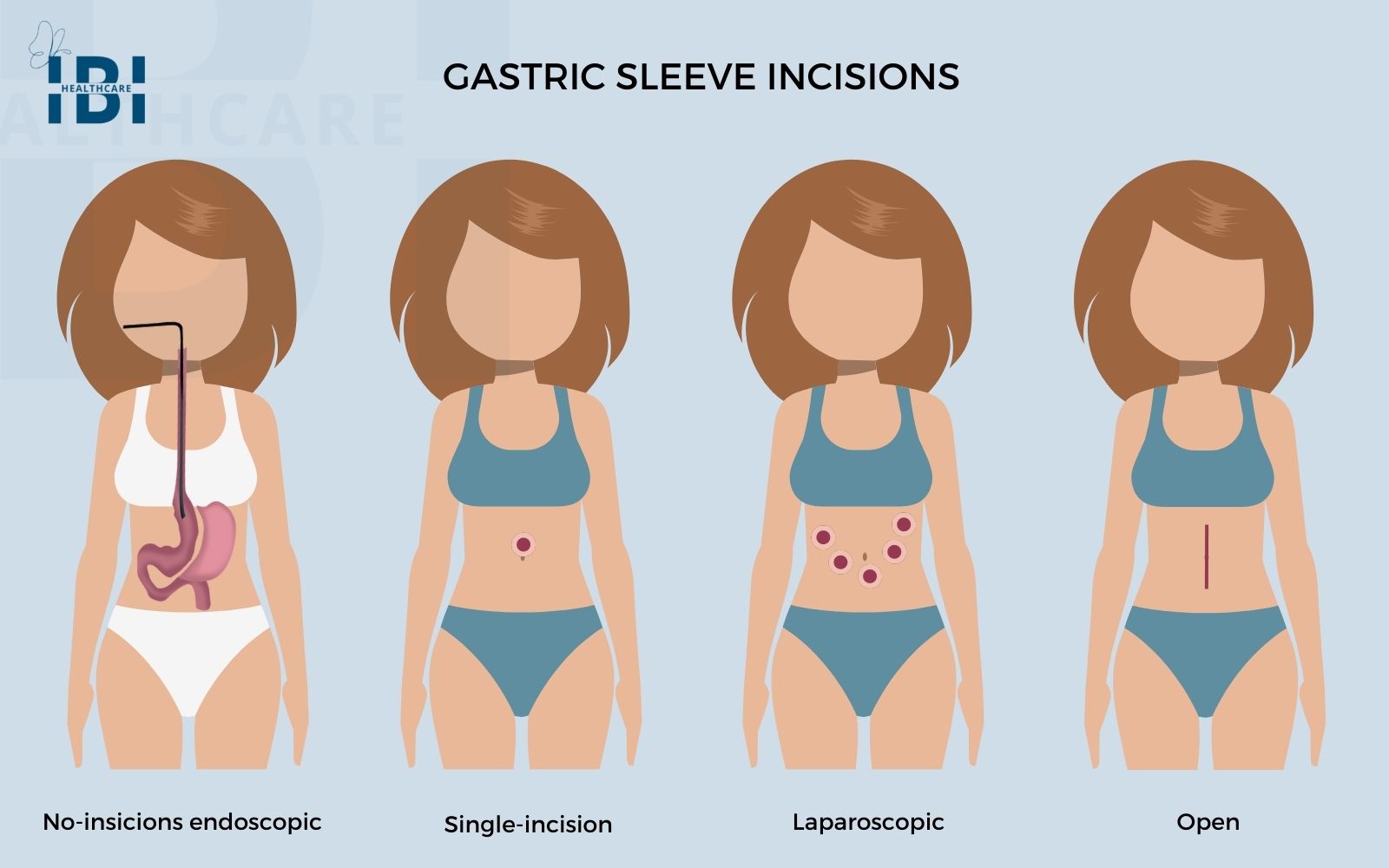 Gastric Sleeve Incisions & Scars Is Scarless Alternative Available?